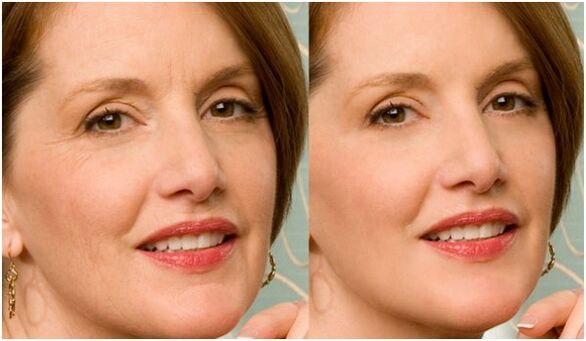 before and after plasma facial renewal