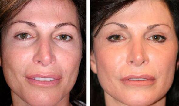 image before after the renewal of the plasma facial skin