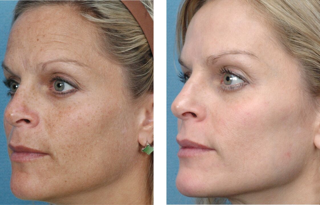 image before and after skin rejuvenation 1