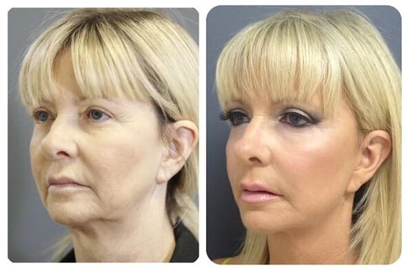 before and after skin rejuvenation with curing image 2