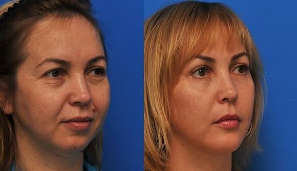 before and after skin rejuvenation with hardened figure 1