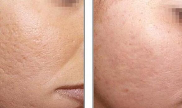 image before and after laser rejuvenation