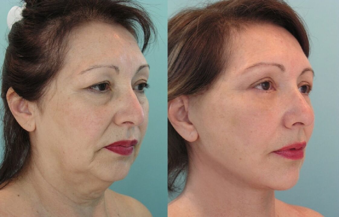 Before and after facelift thread