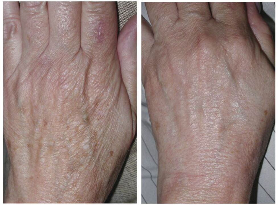 laser rejuvenation for before and after photos